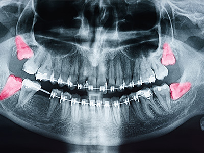 Comfort Care Dental | All-on-6 reg , Dental Cleanings and Teeth Whitening