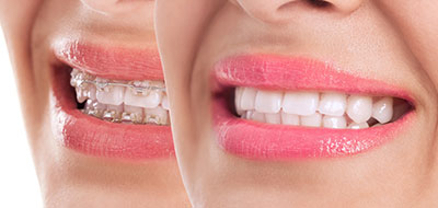 Comfort Care Dental | Extractions, Teeth Whitening and Night Guards