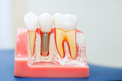 Comfort Care Dental | Emergency Treatment, Ceramic Crowns and Veneers