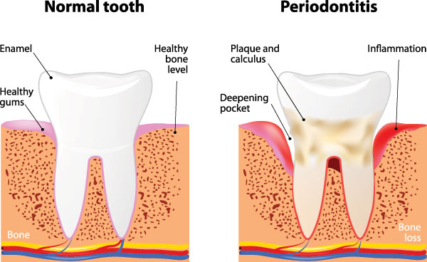 Comfort Care Dental | All-on-4 reg , Wisdom Teeth and Oral Cancer Screening