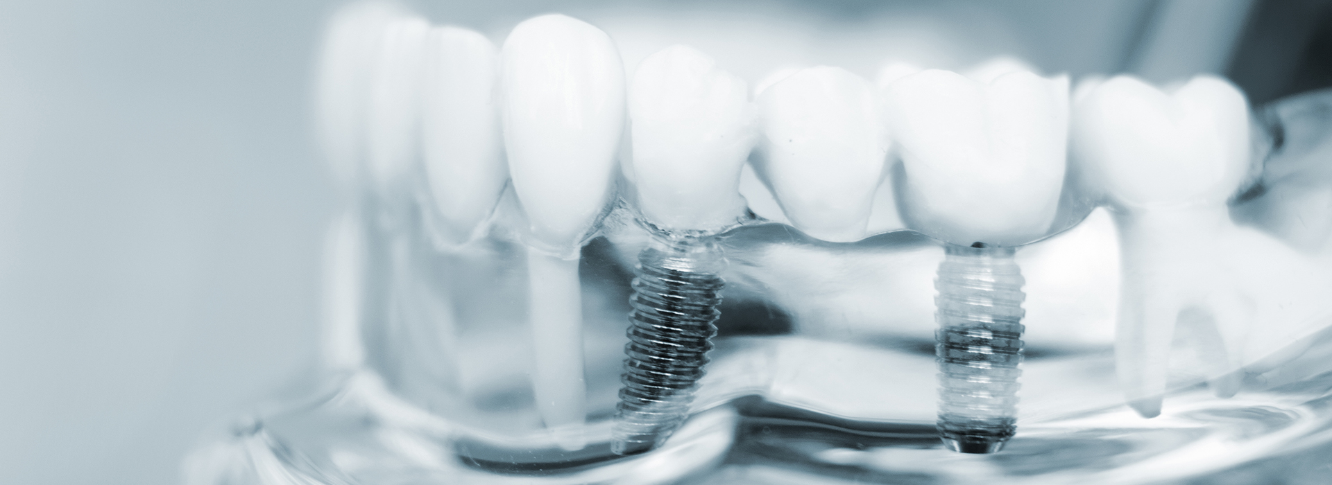 Comfort Care Dental | Oral Exams, Preventative Program and Teeth-In-A-Day  