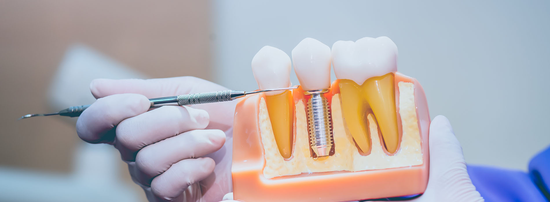 Comfort Care Dental | All-on-4 reg , Night Guards and Dental Bridges